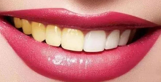 自(zì)然美(měi)白(bái)牙齒的(de)方法有(yǒu)哪些(xiē)？ 